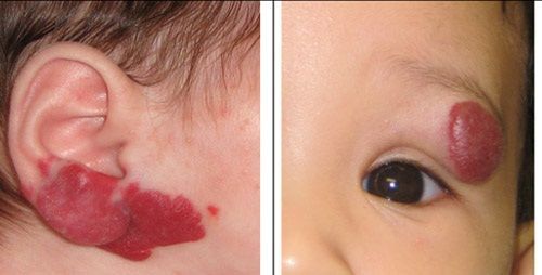 U mạch - Hình ảnh minh họa